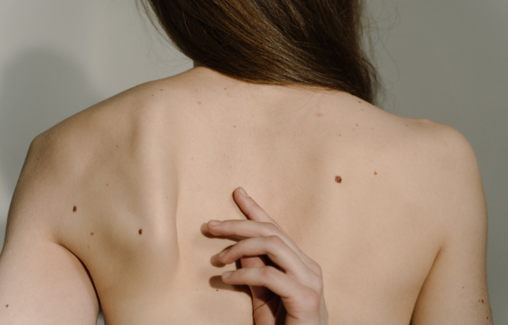 KERATOSIS  SEBORRHOICA