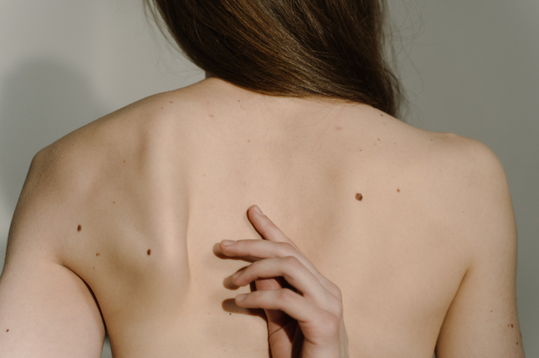 Prvi znak starenja kože? KERATOSIS  SEBORRHOICA