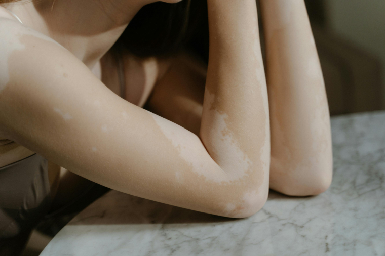 Zašto koža mestimično postane bela? Da li je to Vitiligo?